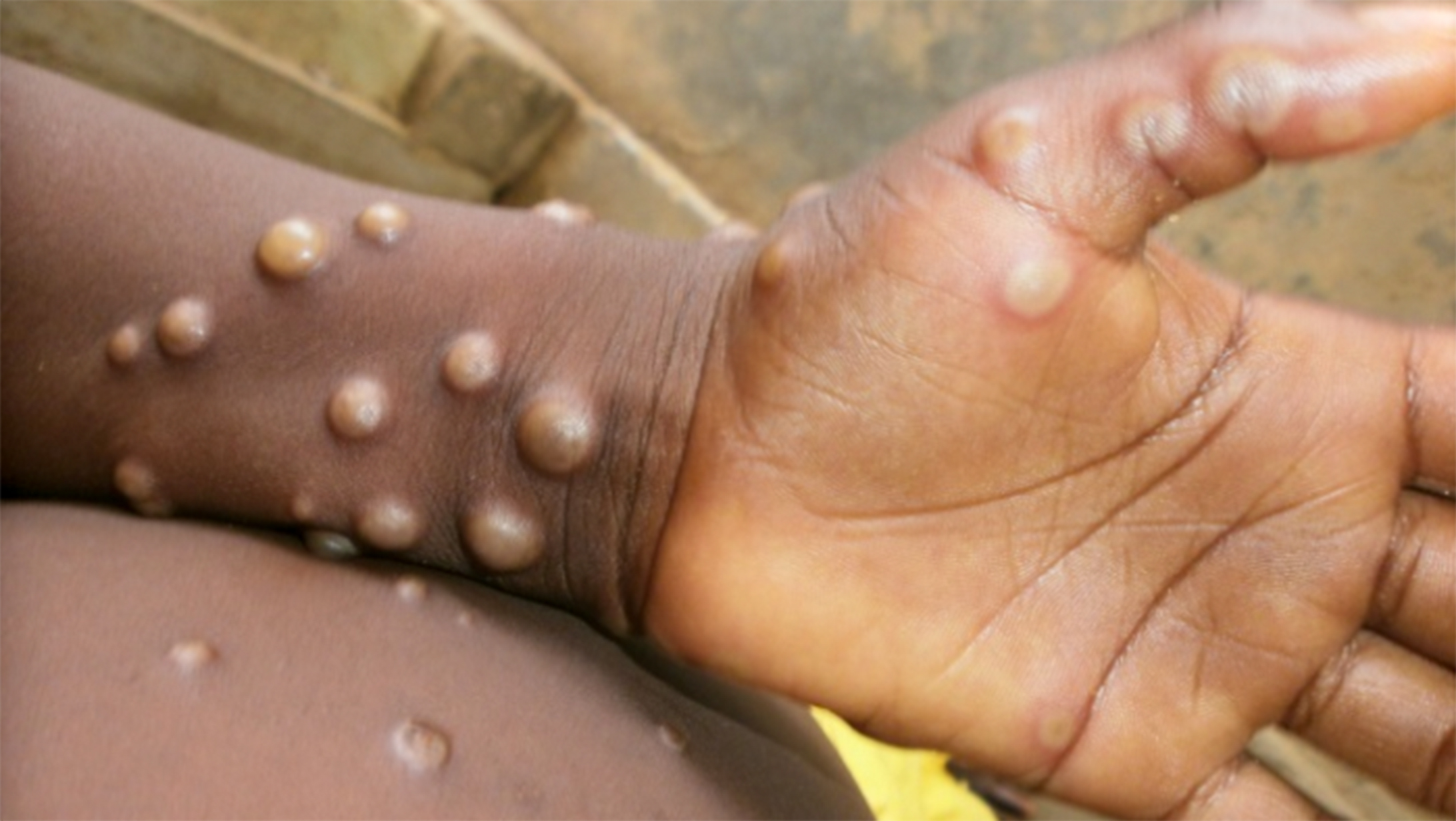 Monkeypox Explained: What You Need to Know to Stay Safe
